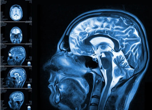 MRI Results SJRA